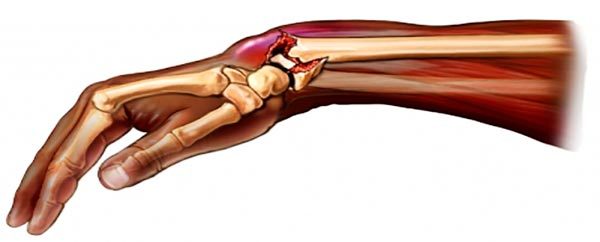 Перелом лучевой кости руки. Лечение костей руки после перелома