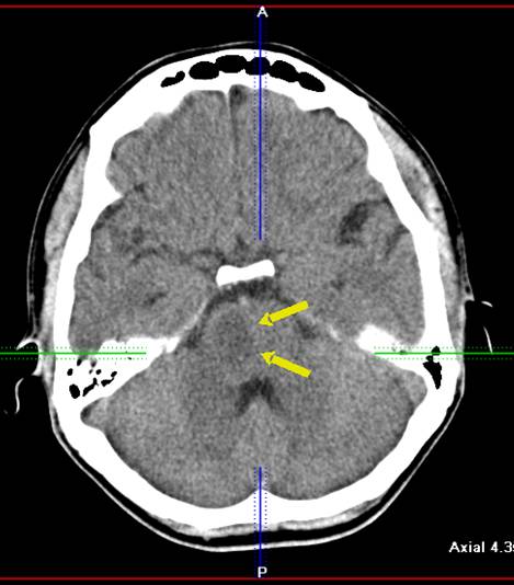 Участок ишемии. Стволовой ишемический инсульт на кт. Ишемический инсульт в стволе головного мозга кт. ОНМК В мосту головного мозга кт. Ишемический инсульт ствола головного мозга на мрт.